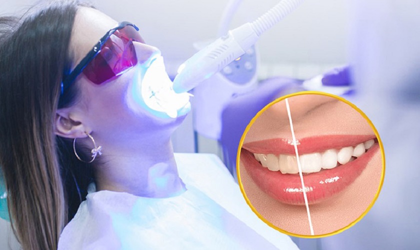 Tẩy trắng răng công nghệ Laser tân tiến